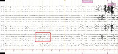 Case report: Refractory focal motor seizure associated with cerebrospinal fluid neurochondrin antibody